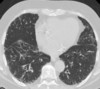 chronic br CT