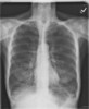 Emphysema PA