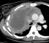 Lymphoma axial CT