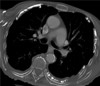 Asbestos calcified plaques CT