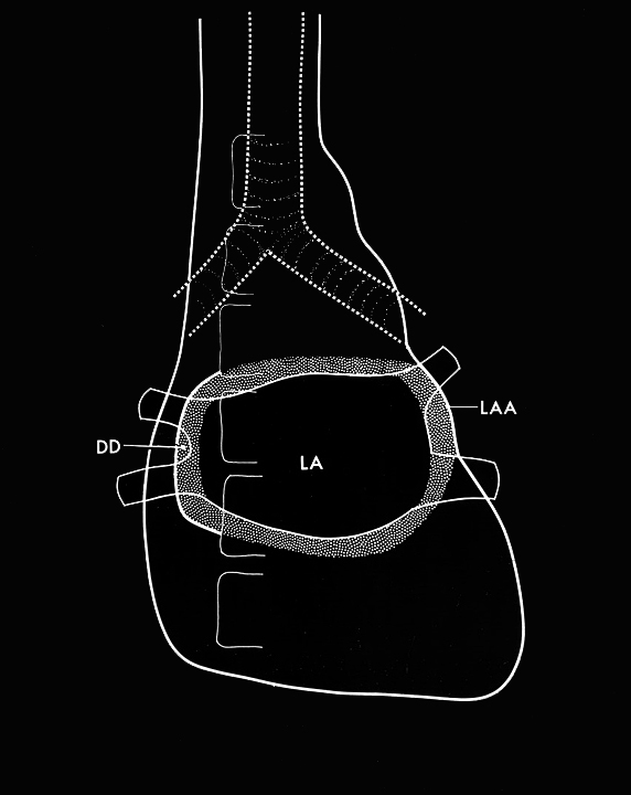 Left atrial enlargement