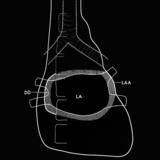 Left atrial enlargement