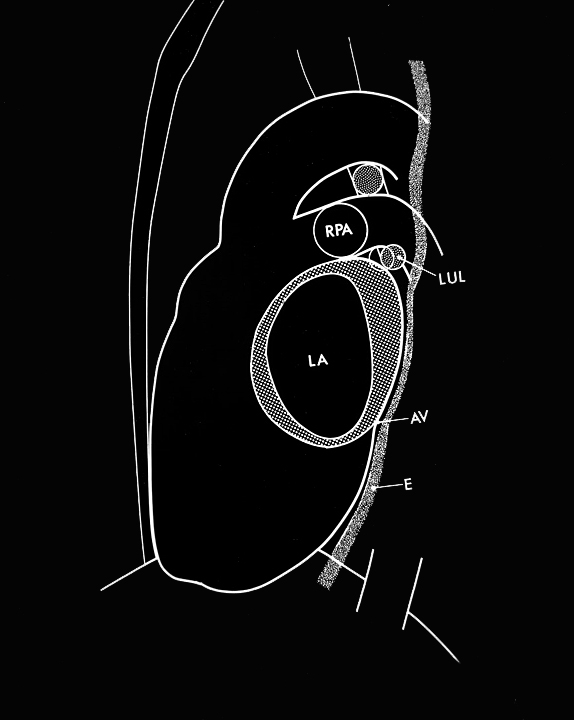 Left atrial enlargement