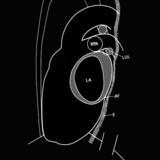 Left atrial enlargement