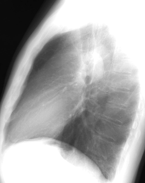 Pulm Stenosis Lat