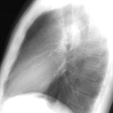 Pulm Stenosis Lat