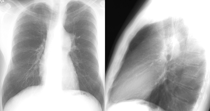 Pulm Stenosis