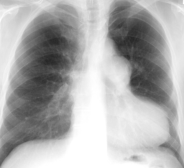 Pulm Stenosis 2 PA