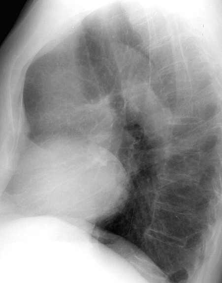 Pulm Stenosis 2 Lat