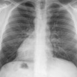 Dextrocardia