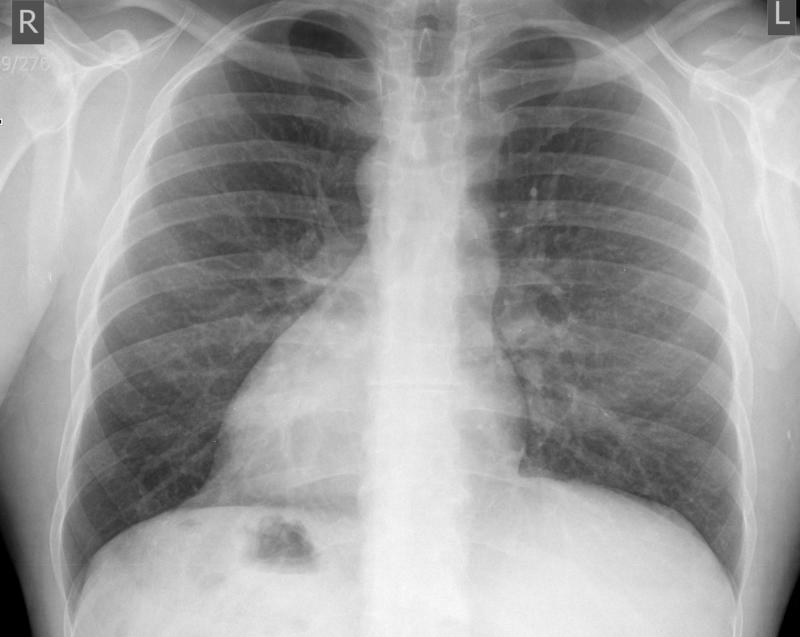 Dextrocardia