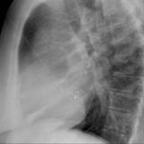 clam shell ASD lat
(diff patient)