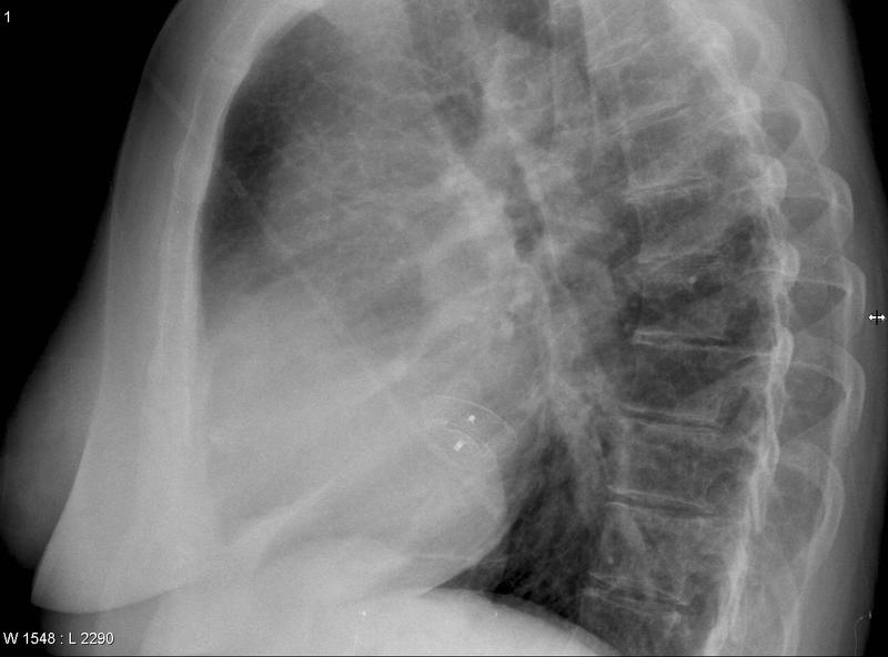 clam shell ASD lat
(diff patient)