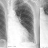 CHF progression