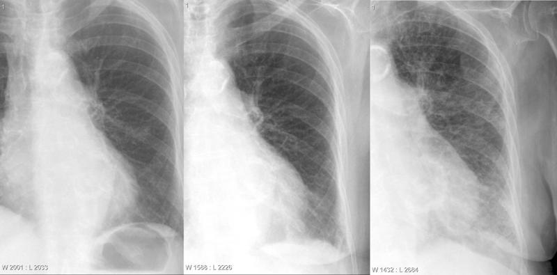 CHF progression