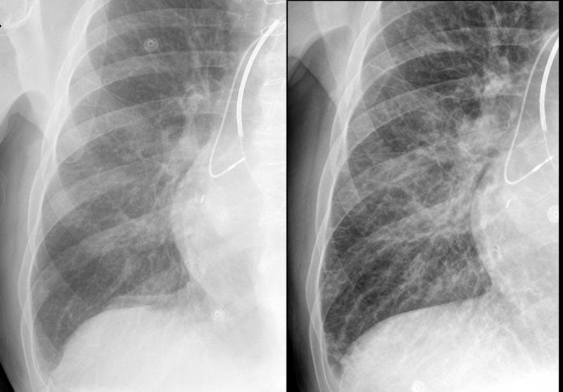 IPE before and after