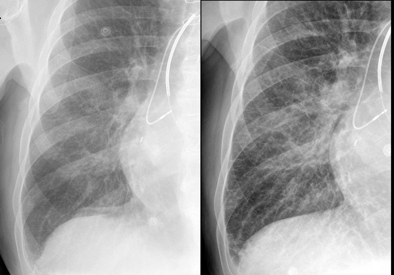 IPE before and after