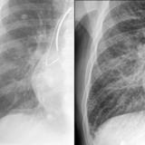 IPE before and after