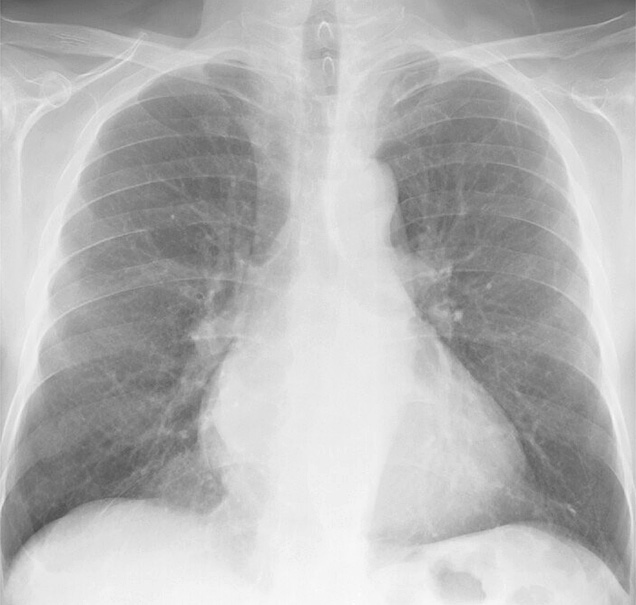 Mitral Valve Disease
Case 1 PA
