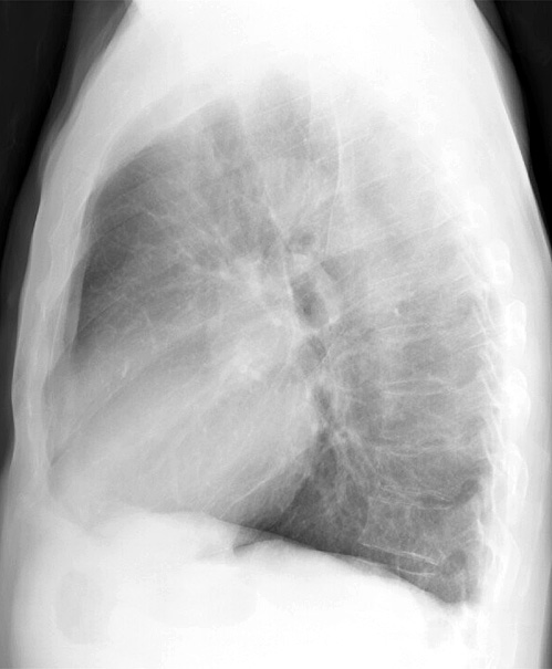 Mitral Valve Disease
Case 1 Lat