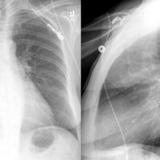 Mitral Valve Disease
Case 2 PA and Lat