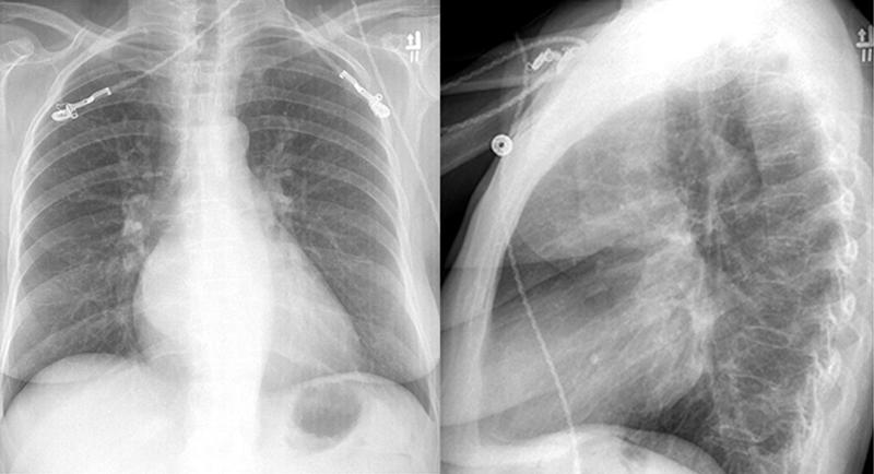 Mitral Valve Disease
Case 2 PA and Lat