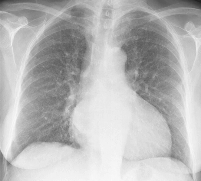 Mitral Valve Disease
Case 3 PA