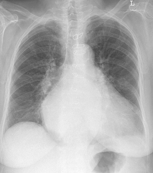 Mitral Valve Disease
Case 4 PA