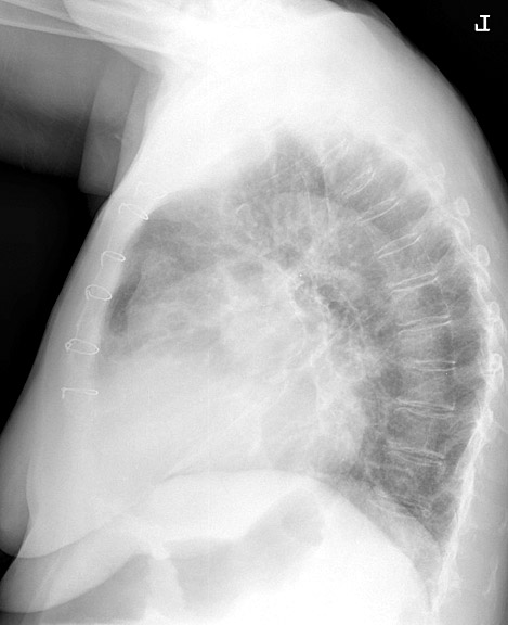 Mitral Valve Disease
Case 4 Lat
