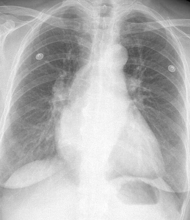 Mitral Valve Disease
Case 5 PA