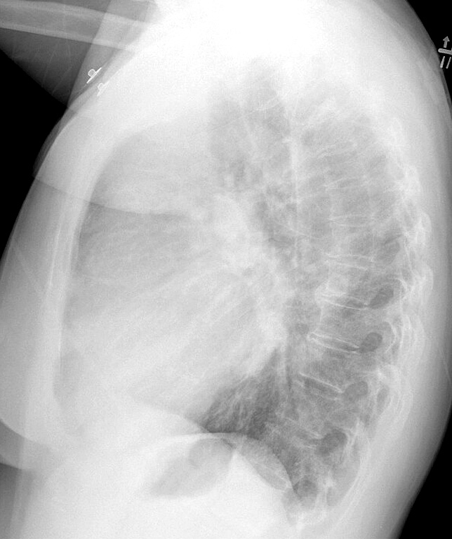 Mitral Valve Disease
Case 5 Lat