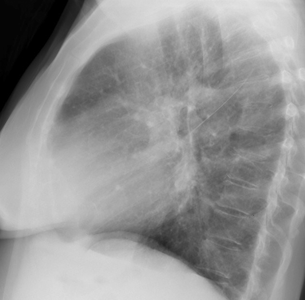 Mitral Valve Disease
Case 6 Lat