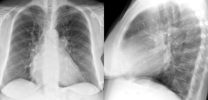 Mitral Valve Disease
Case 6 Pa and lat