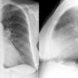 Mitral Valve Disease
Case 6 Pa and lat