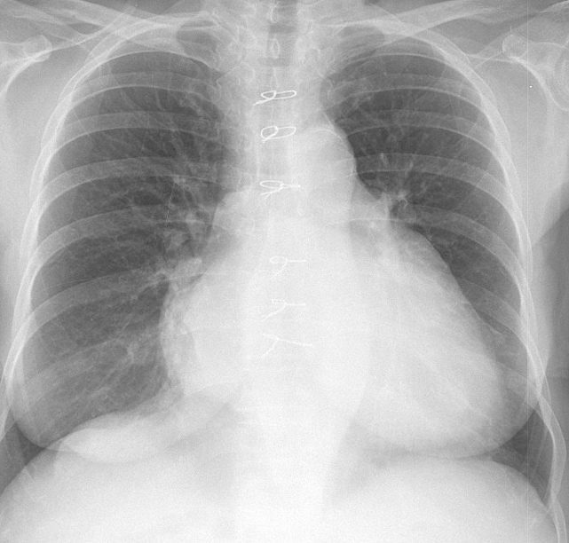 Mitral Valve Disease
Case 7 PA