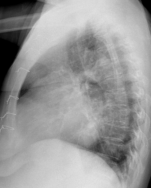 Mitral Valve Disease
Case 7 Lat