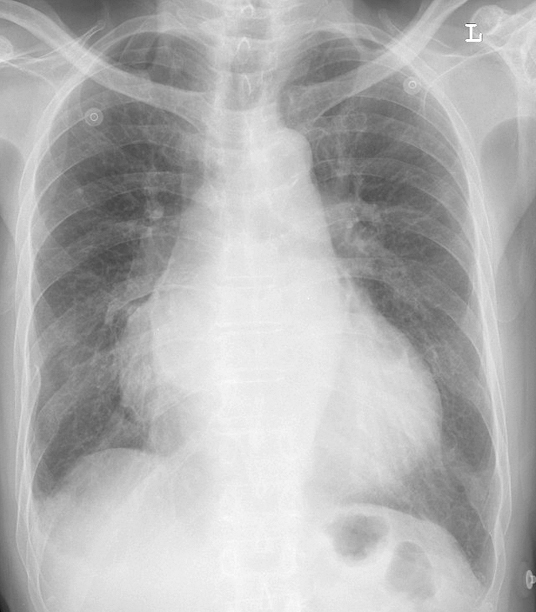 Mitral Valve Disease
Case 8 PA