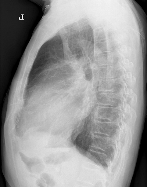 Mitral Valve Disease
Case 8 Lat