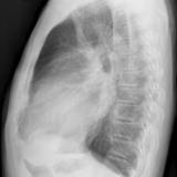 Mitral Valve Disease
Case 8 Lat