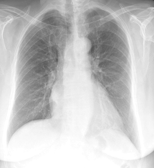 Mitral Valve Disease
Case 9 PA