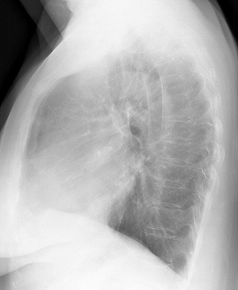 Mitral Valve Disease
Case 9 Lat