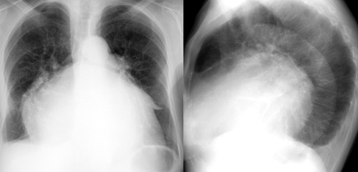 Mitral Valve Disease
Case 11