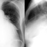 Mitral Valve Disease
Case 11