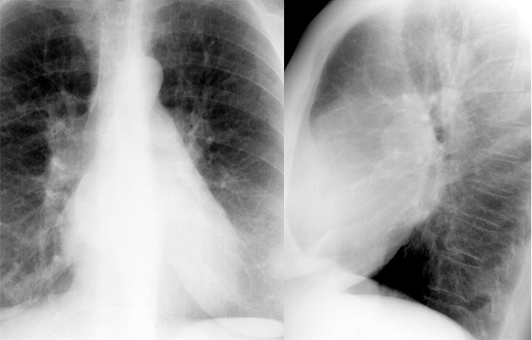 Mitral Valve Disease
Case 12