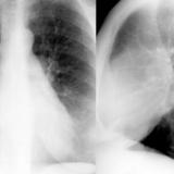 Mitral Valve Disease
Case 12