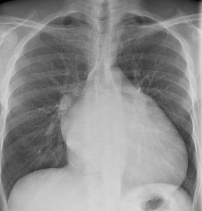 Mitral Case 13 PA