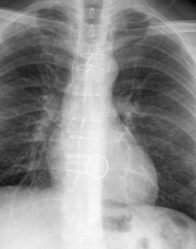 Mitral annuloplasty PA