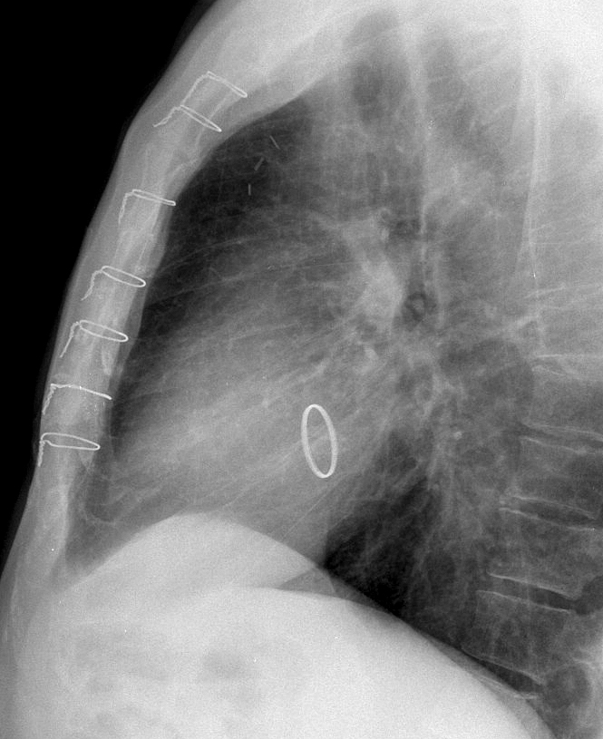 Mitral annuloplasty Lat