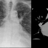 Enlarged Lt atrium, splaying