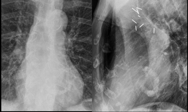 Mitral annulus